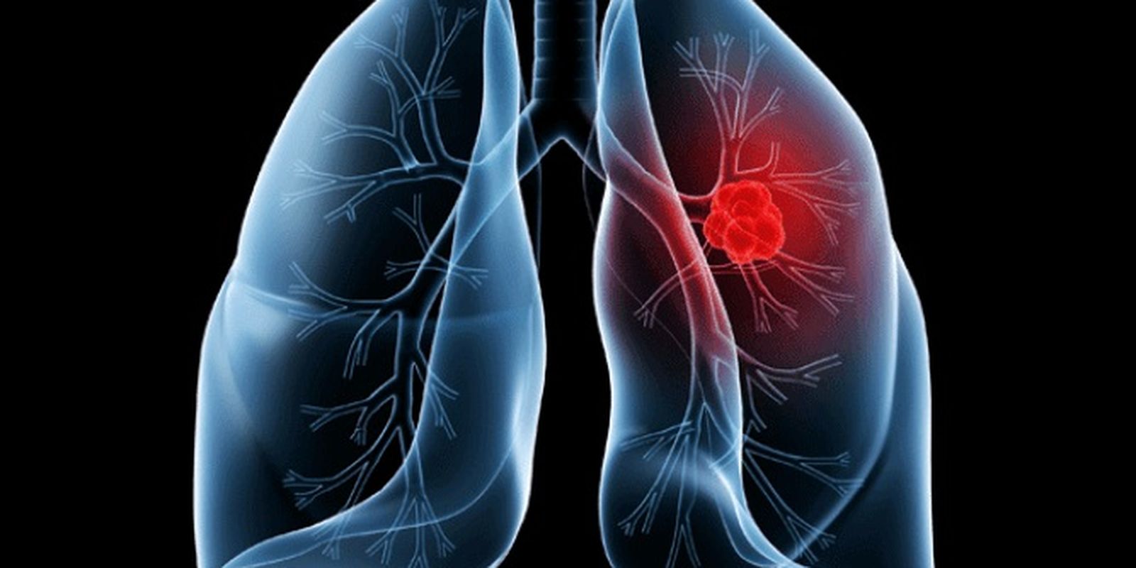 Papa Leão é operado após diagnóstico de adenocarcinoma pulmonar